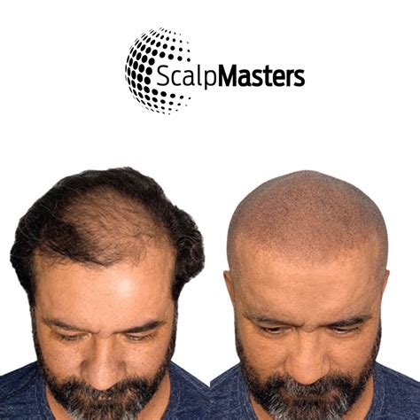 Is Scalp Micropigmentation Worth It? | ScalpMasters