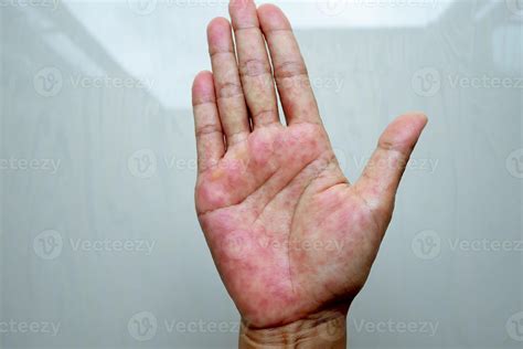 Atopic Dermatitis Hands