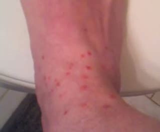 Chiggers Rash Pictures, Treatment, Causes, Symptoms