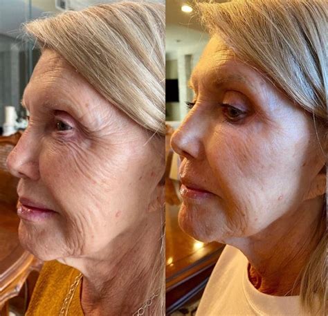 Fibroblast Plasma Pen Before & Afters — Skin Studio OKC