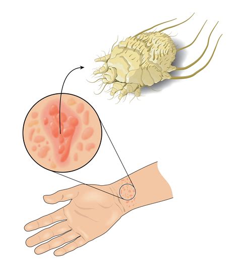 What Is Scabies? Symptoms, Causes, Diagnosis, Treatment,, 42% OFF