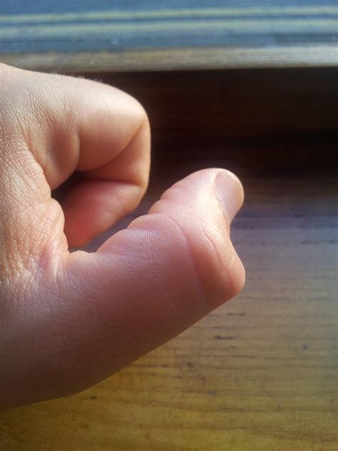 Bump On Knuckle That Hurts