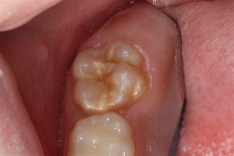 Aufklärung und richtige Prävention bei Kindern mit MIH – ZWP online