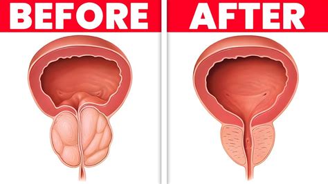 How to Shrink an Enlarged Prostate Naturally