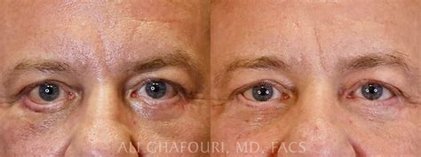 Revisional Eyelid Surgery in Scottsdale & Phoenix | Dr. Ghafouri