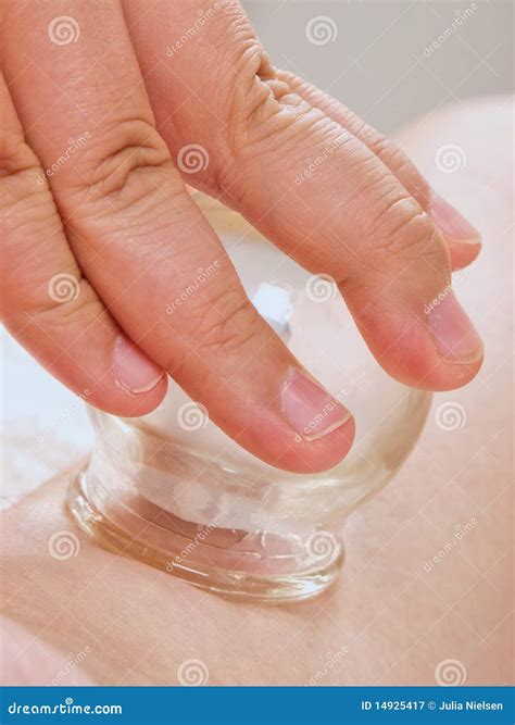 Chinese Cupping Points at Anitra Bourne blog