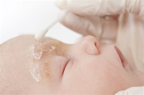 Seborrhoisches Ekzem: Symptome, Behandlung und Leben mit der Erkrankung