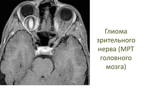 Нейрофиброматоз I типа - презентация онлайн
