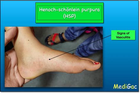 Henoch-Schonlein Purpura(HSP) – Clinical features || Pathophysiology ...