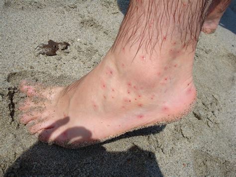 Alergia A Picada De Borrachudo