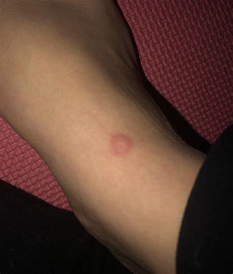 Could this be a spider bite? I’ve had it for like 2 days & it doesn’t ...