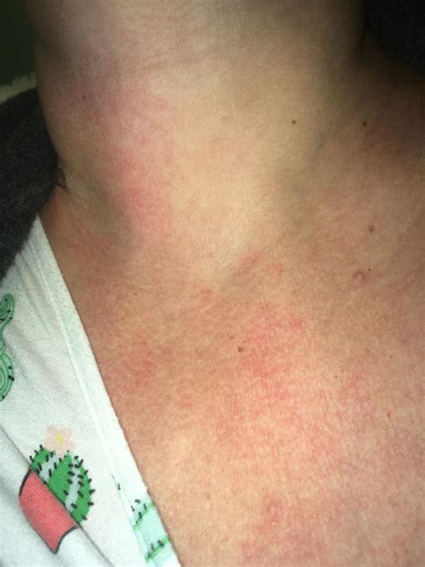 My son is the diagnosed one, with Cold Urticaria, Cholinergic Urticaria