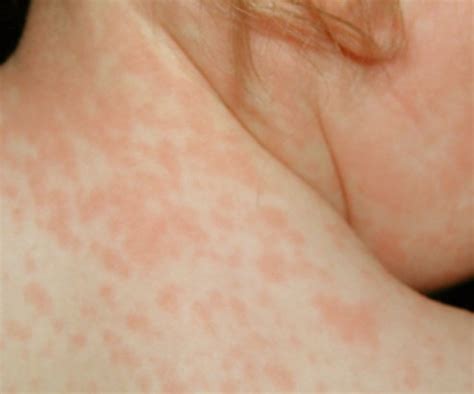 Roseola Rash | Good Health