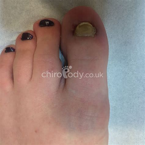 Toenail reconstruction | Services | Manchester Podiatry | Leading