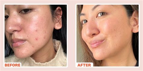 Radiofrequency Microneedling for Acne Scars Before and After