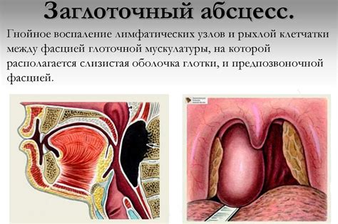 Заглоточный абсцесс: причины, симптомы, диагностика и лечение