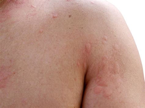 Hives symptoms and treatments - Dermatology Boca Raton Dermatologist ...