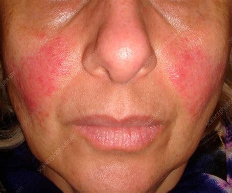 acne rosacea - DrBeckmann