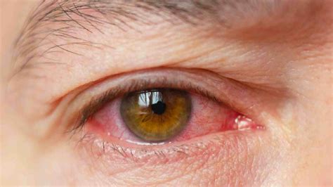 conjunctivitis symptoms types  treatment prevention