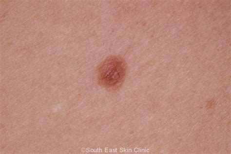 Seborrhoeic Keratosis - How to idenitify Seb K - Extensive Gallery.