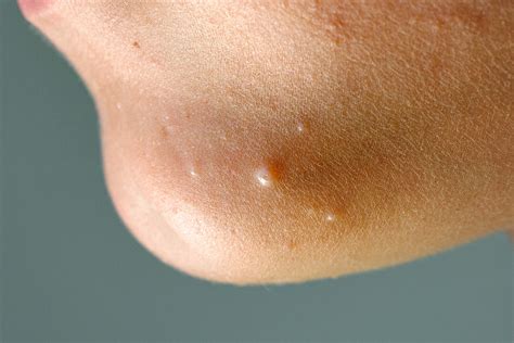 Molluscum Contagiosum