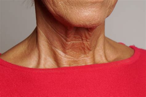 Neck Sagging - Dr Victoria Gauba
