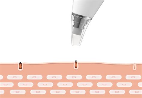 inFace Blackhead MS7000 in crowdfunding, pulizia del viso fai da te ...