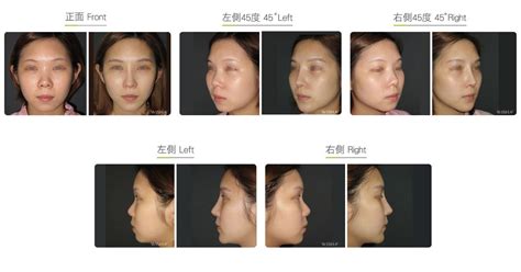 Short Nose (Upturned Nose) Correction | WishClinic