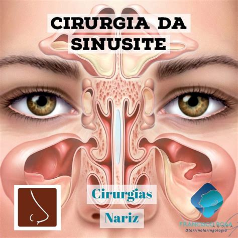 Cirurgia De Sinusite Antes E Depois
