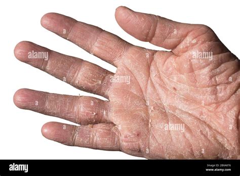 Contact Dermatitis Palms