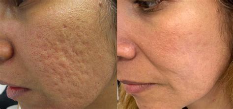 Professional Microneedling acne scars Treatment in Brisbane