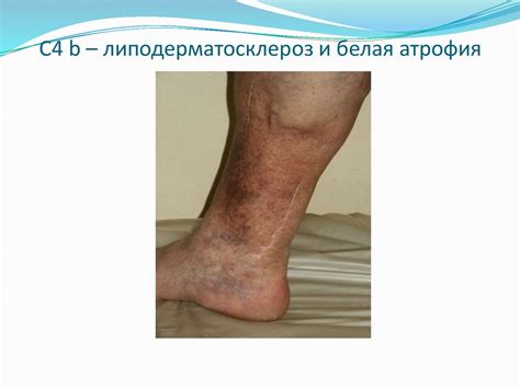 Нарушение венозного кровообращения конечностей - презентация онлайн