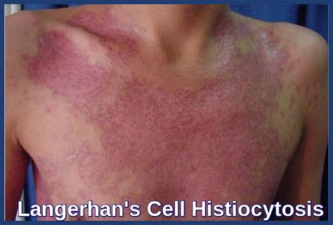 Langerhans Cell Histiocytosis Skin Lesions