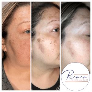 Sciton Forever Young BBL - Renew Medical Aesthetics