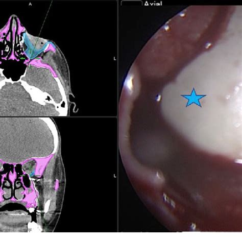 Slices of the CT scan with the correction of the orbital floor. 3D... | Download Scientific Diagram