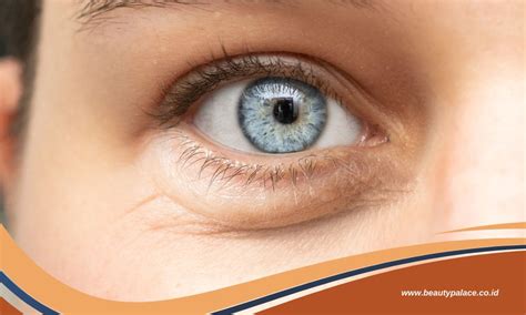 3 Solusi Treatment Untuk Problem Pada Kantung Mata