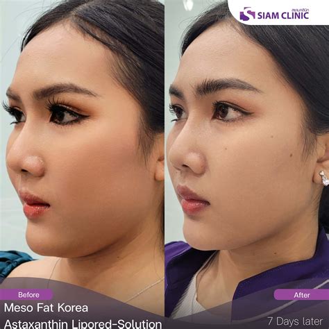 Fat Reduction Before and After Photos - Siam Clinic Thailand