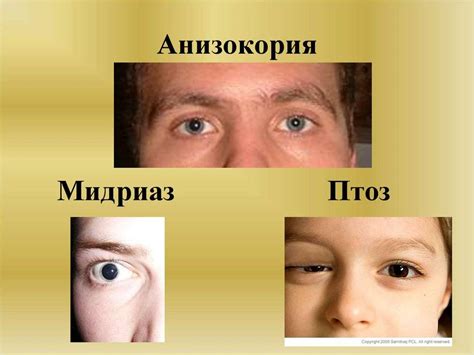 Анизокория: причины, симптомы, диагностика, лечение