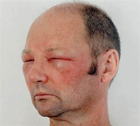 Photos Showing How Bad an Allergic Reaction Can Be | eBaum's World