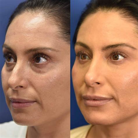 Eye Fillers Under Eye at Eileen Hammond blog