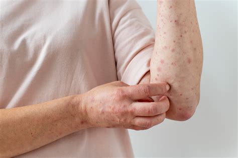 Understanding Lymphoma Rash: Early Signs and What to Do Next ...