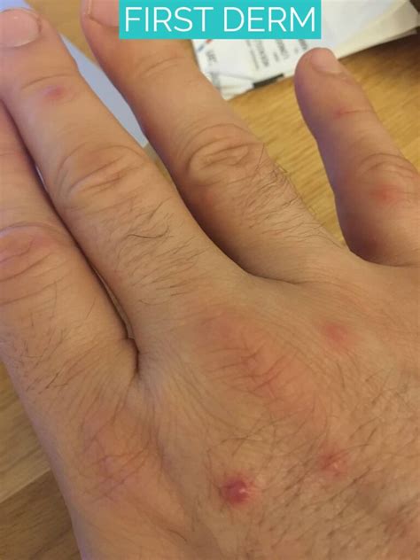 Hand Foot And Mouth Disease Adults How Long Does It Last Hand, Foot,