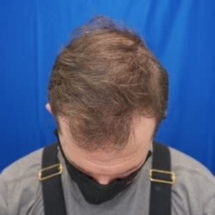 Hair Restoration Before & After Photos - Precision Calgary