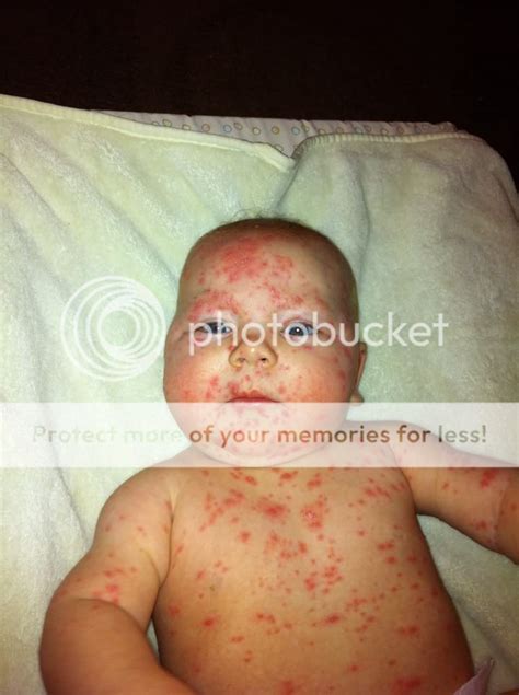How Soon Can A Baby Get Chicken Pox at Rhonda William blog