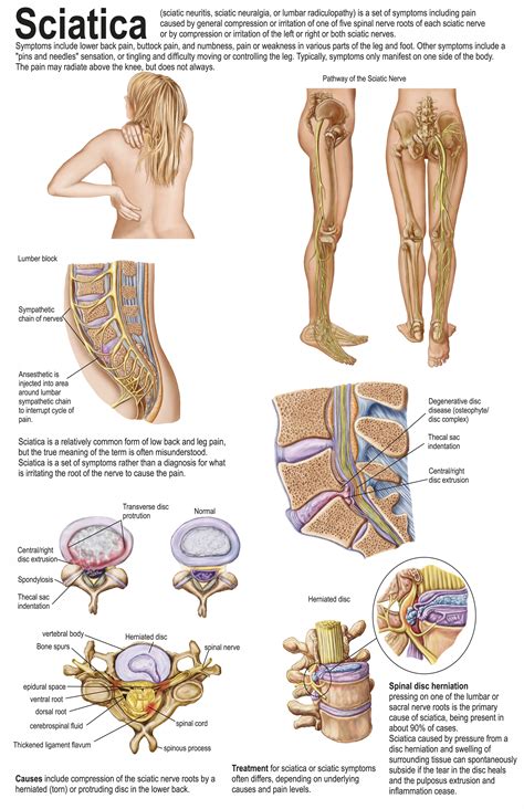 3 Sciatica Stretches That Will Help to Vanquish Your Low Back Pain ...