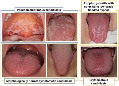 Oral Candida Under Tongue