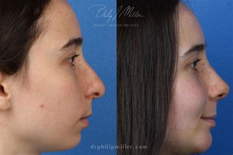 Pollybeak (Supratip) Deformity - Philip Miller MD