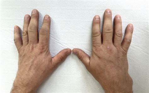 ra tutor understanding rheumatoid arthritis  easy