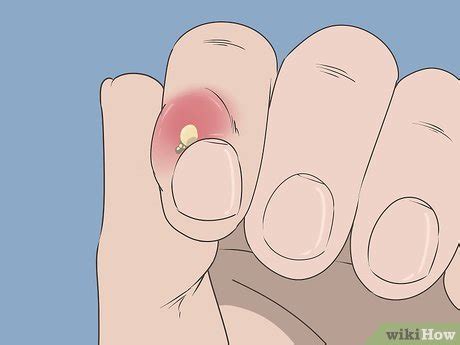 how to draw an infection out of a finger