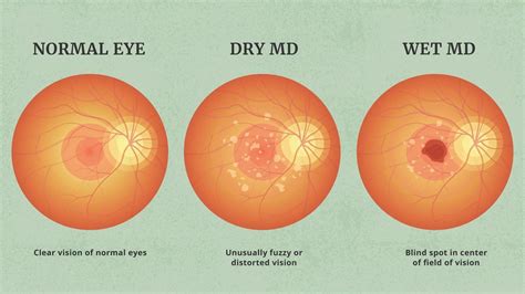 The Latest Advancements in the Treatment of Age-Related Macular ...